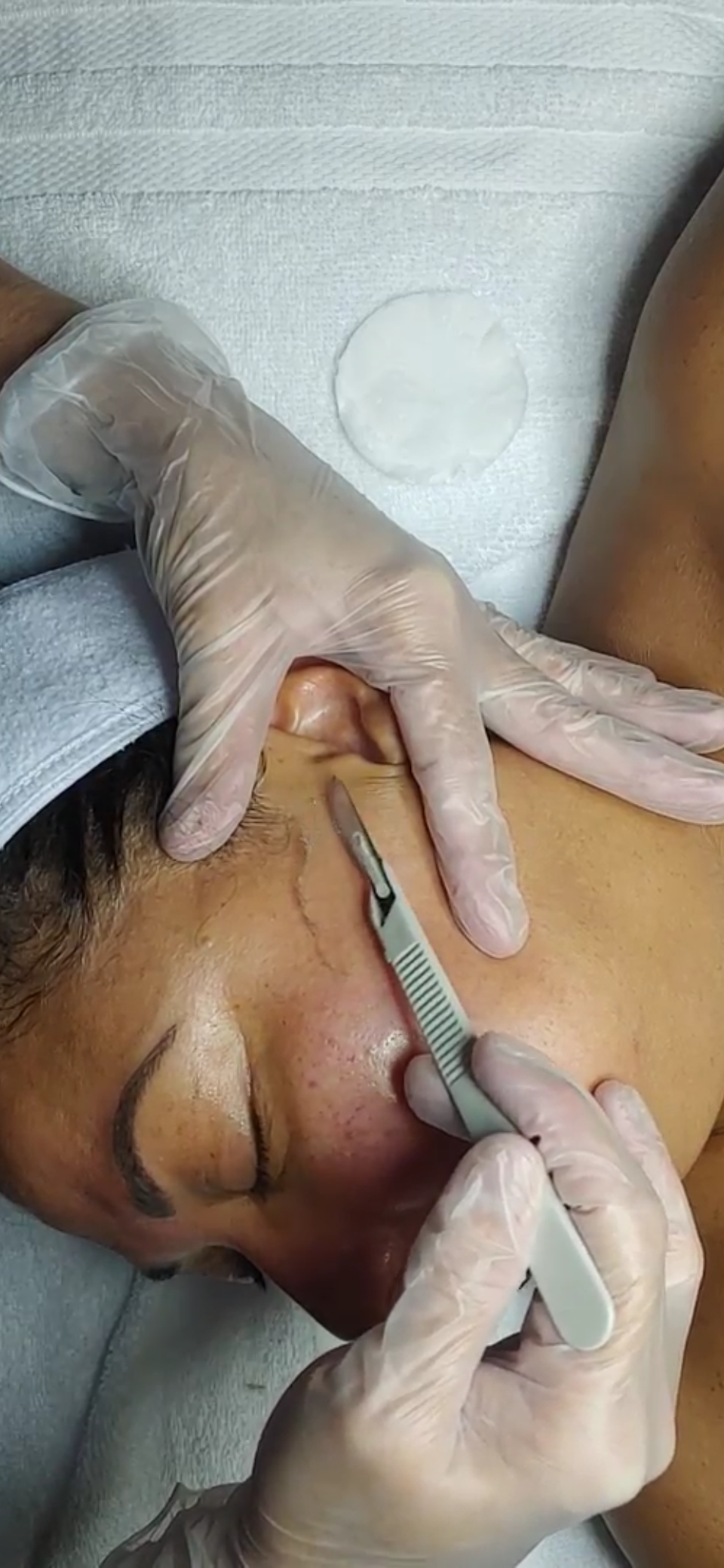 Dermaplaning in the Treatment Room