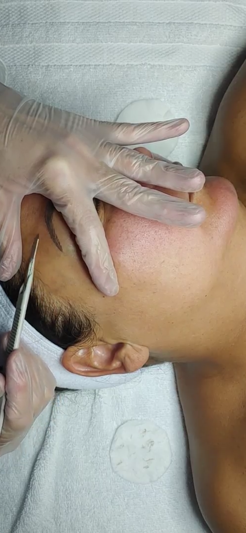 Dermaplaning in the Treatment Room